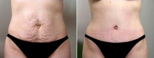 abdominoplastie-Tunisie