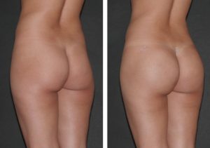 augmentation-fesse-Tunisie